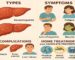 کبد چرب: انواع، علائم، عوارض و درمان خانگی و پیشگیری کامل